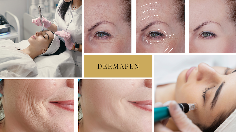 Image of Dermapen Microneedling - Ansikte