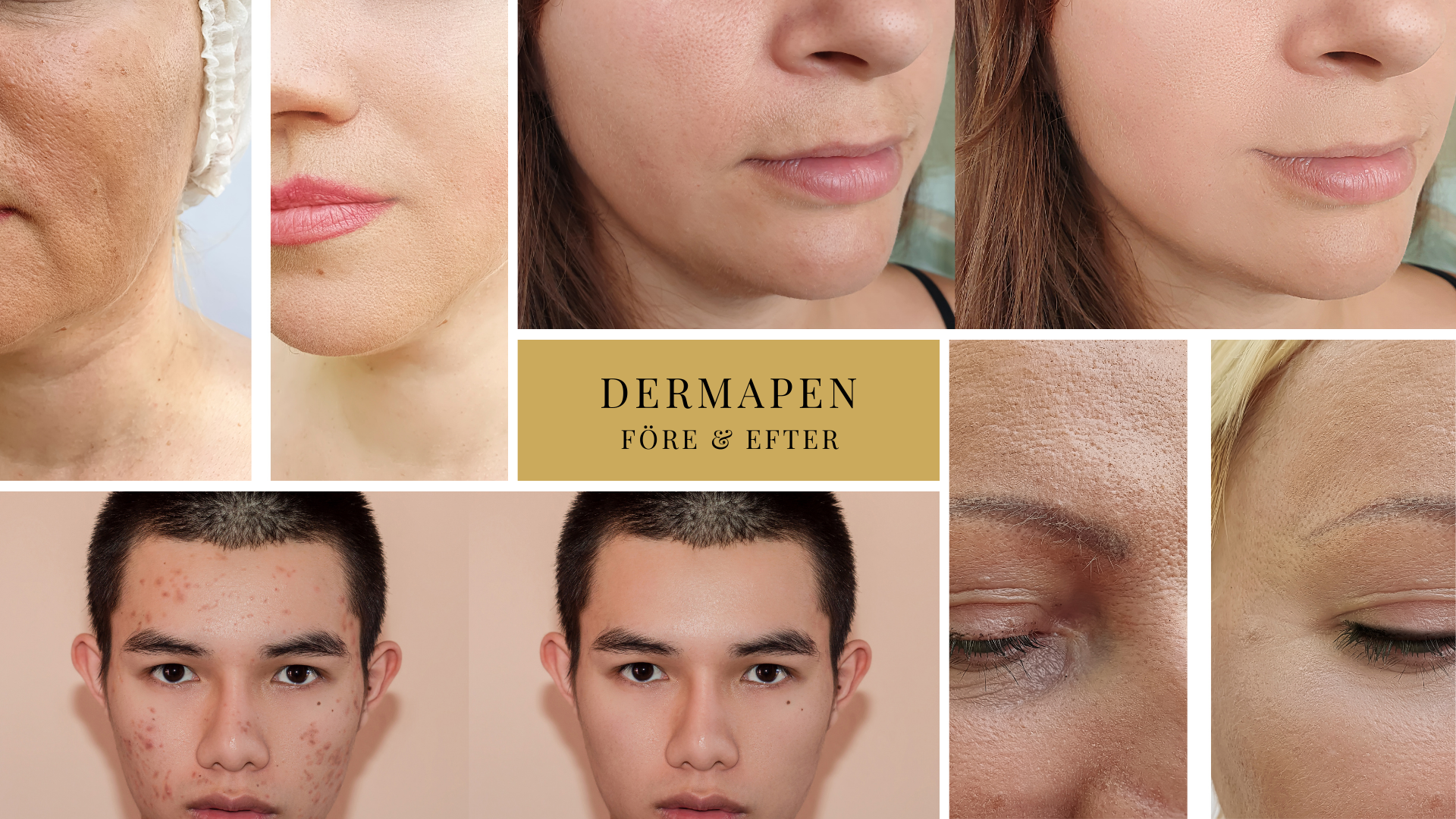 Image of Dermapen Microneedling - Ansikte