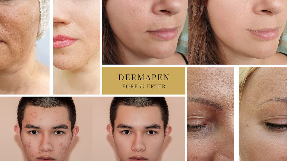 Image of Dermapen Microneedling - Ansikte