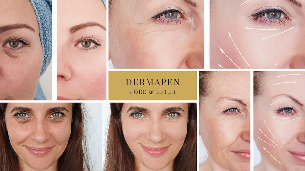 Image of Dermapen Microneedling - Ansikte + Hals